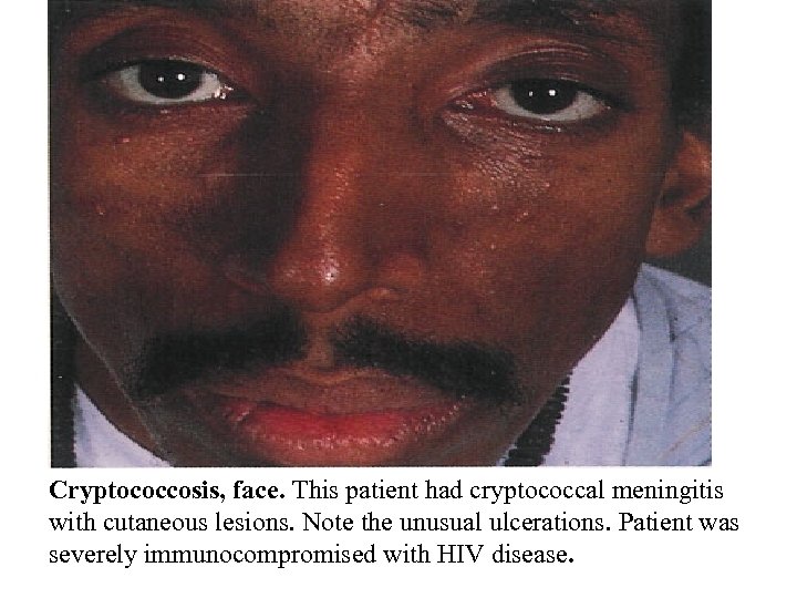 Cryptococcosis, face. This patient had cryptococcal meningitis with cutaneous lesions. Note the unusual ulcerations.