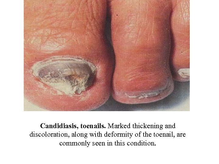 Candidiasis, toenails. Marked thickening and discoloration, along with deformity of the toenail, are commonly