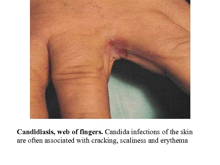 Candidiasis, web of fingers. Candida infections of the skin are often associated with cracking,