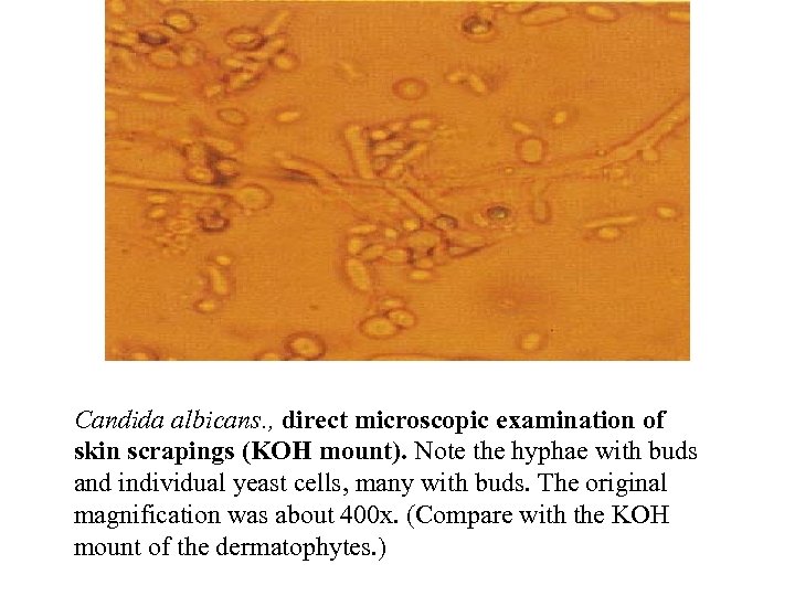 Candida albicans. , direct microscopic examination of skin scrapings (KOH mount). Note the hyphae