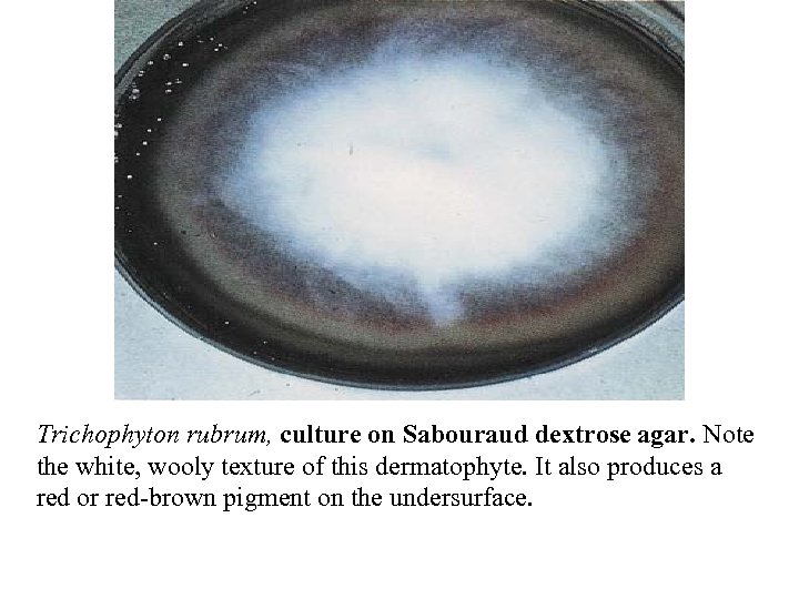 Trichophyton rubrum, culture on Sabouraud dextrose agar. Note the white, wooly texture of this