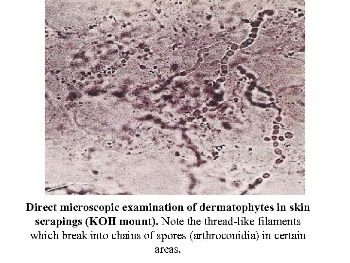 Direct microscopic examination of dermatophytes in skin scrapings (KOH mount). Note thread‑like filaments which