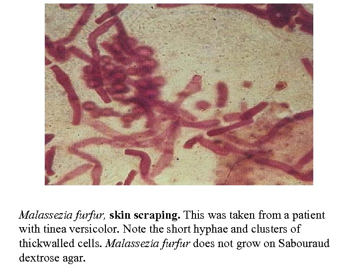 Malassezia furfur, skin scraping. This was taken from a patient with tinea versicolor. Note