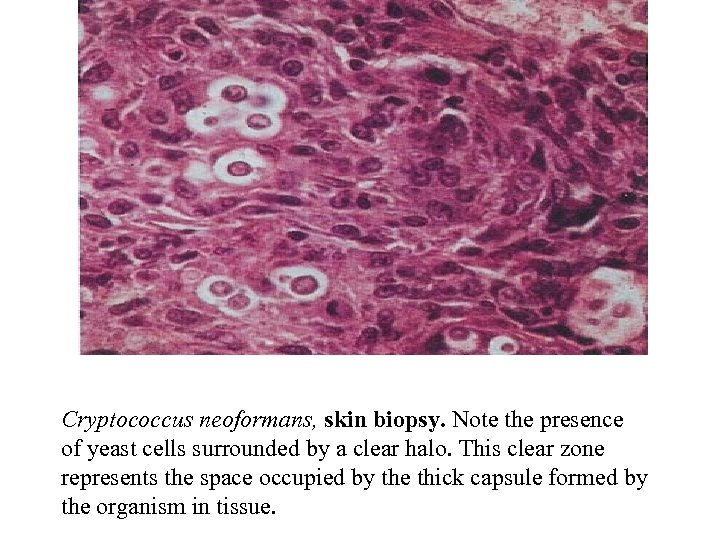 Cryptococcus neoformans, skin biopsy. Note the presence of yeast cells surrounded by a clear