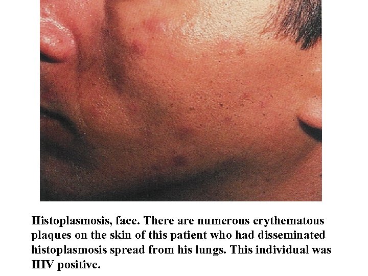 Histoplasmosis, face. There are numerous erythematous plaques on the skin of this patient who