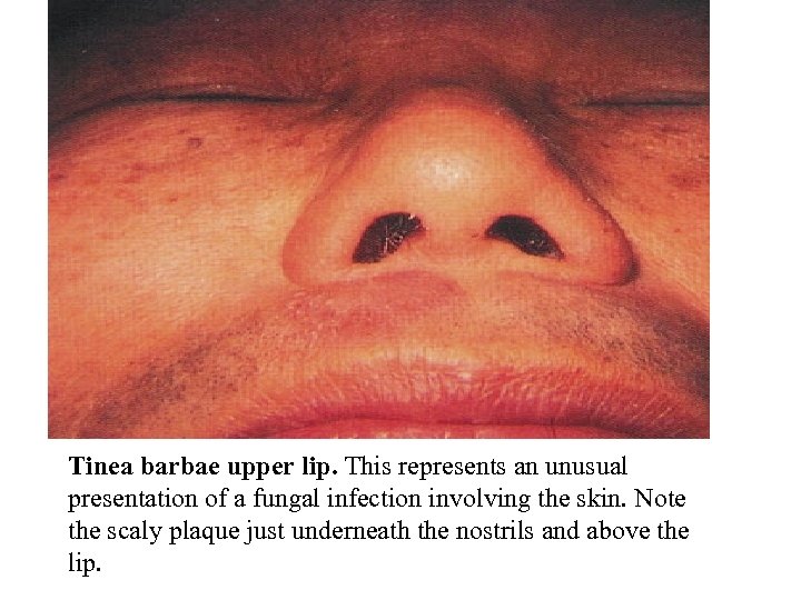 Tinea barbae upper lip. This represents an unusual presentation of a fungal infection involving