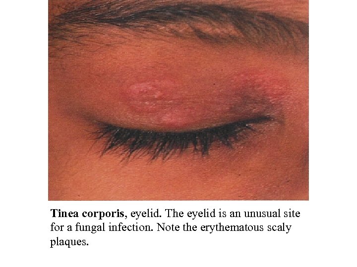 Tinea corporis, eyelid. The eyelid is an unusual site for a fungal infection. Note