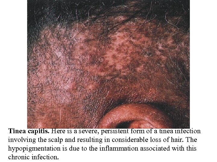 Tinea capitis. Here is a severe, persistent form of a tinea infection involving the