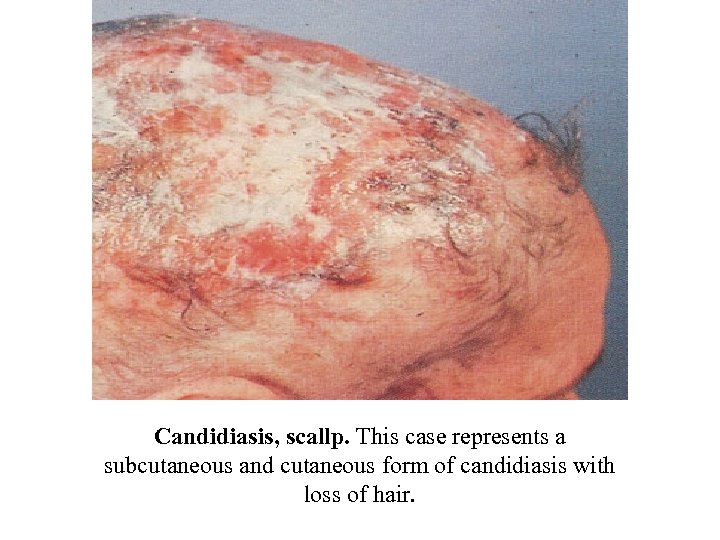 Candidiasis, scallp. This case represents a subcutaneous and cutaneous form of candidiasis with loss