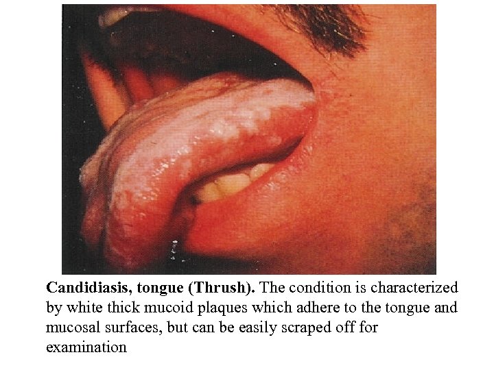 Candidiasis, tongue (Thrush). The condition is characterized by white thick mucoid plaques which adhere