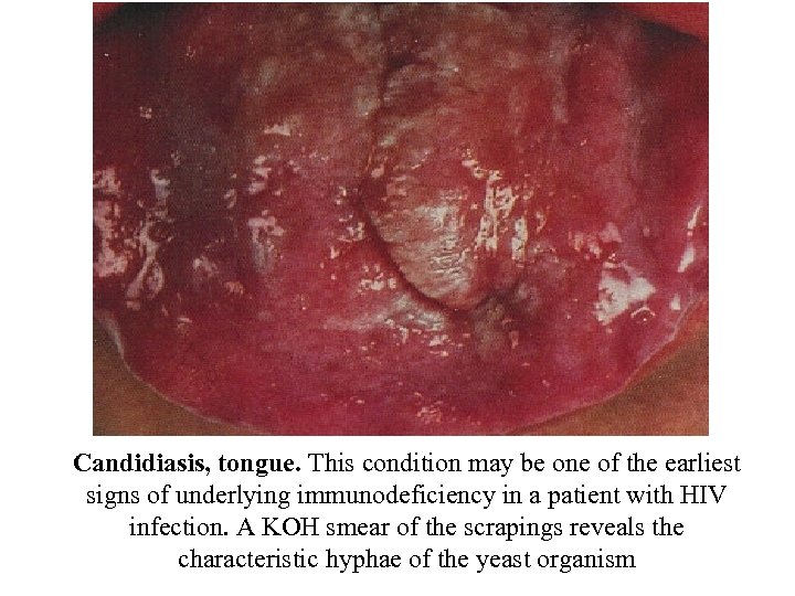 Candidiasis, tongue. This condition may be one of the earliest signs of underlying immunodeficiency