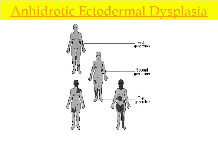 Anhidrotic Ectodermal Dysplasia 