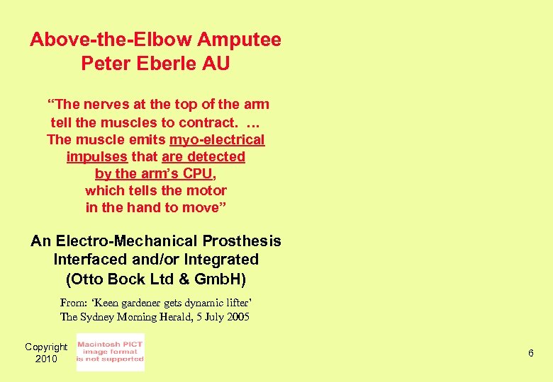 Above-the-Elbow Amputee Peter Eberle AU “The nerves at the top of the arm tell