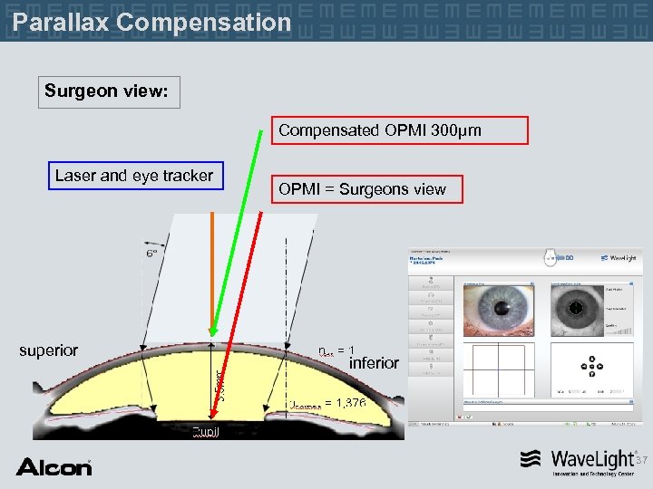 Parallax Compensation Surgeon view: Compensated OPMI 300µm Laser and eye tracker superior OPMI =