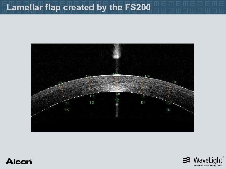 Lamellar flap created by the FS 200 7 