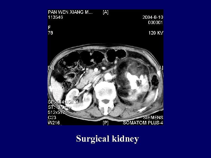 Surgical kidney 