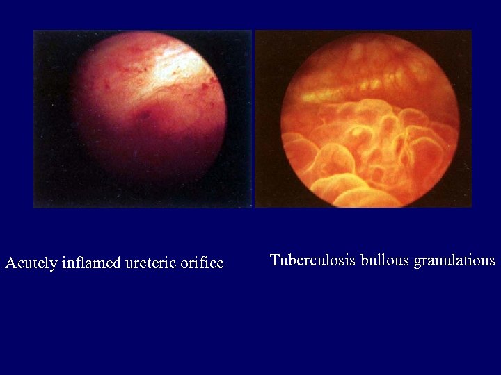 Acutely inflamed ureteric orifice Tuberculosis bullous granulations 