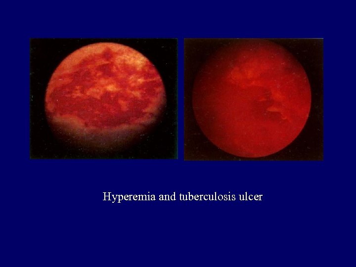 Hyperemia and tuberculosis ulcer 
