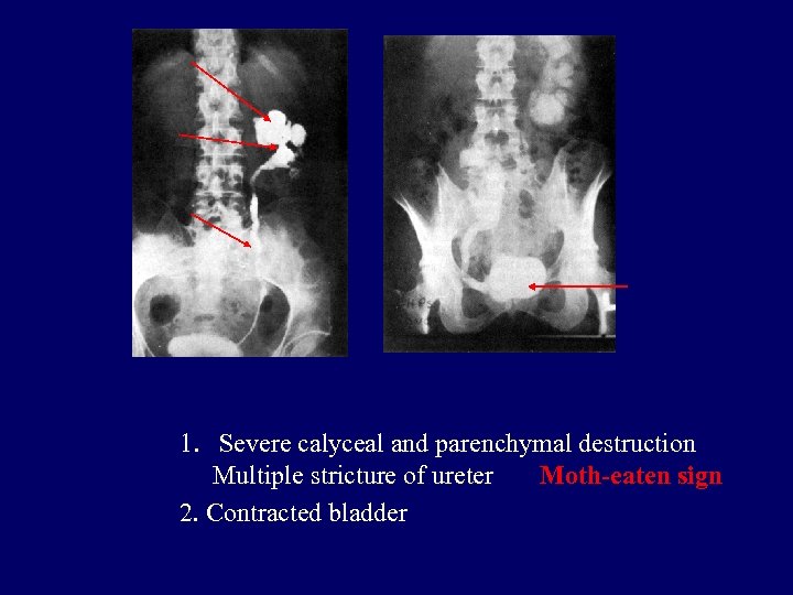 1. Severe calyceal and parenchymal destruction Multiple stricture of ureter Moth-eaten sign 2. Contracted