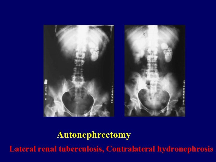 Autonephrectomy Lateral renal tuberculosis, Contralateral hydronephrosis 