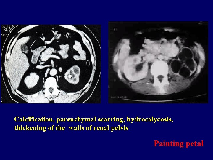 Calcification, parenchymal scarring, hydrocalycosis, thickening of the walls of renal pelvis Painting petal 