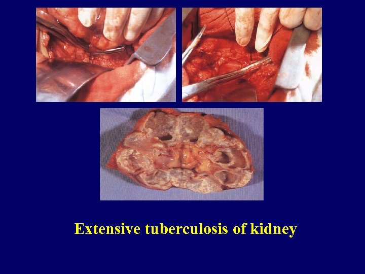 Extensive tuberculosis of kidney 