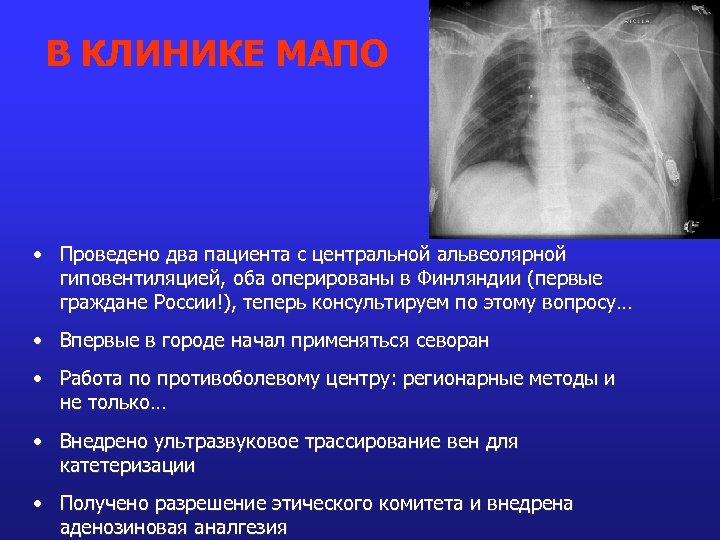 В КЛИНИКЕ МАПО • Проведено два пациента с центральной альвеолярной гиповентиляцией, оба оперированы в
