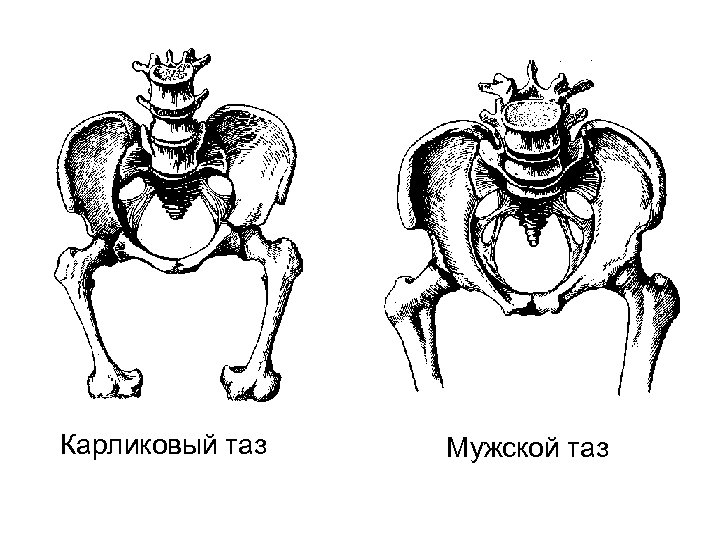 Аномалии таза презентация