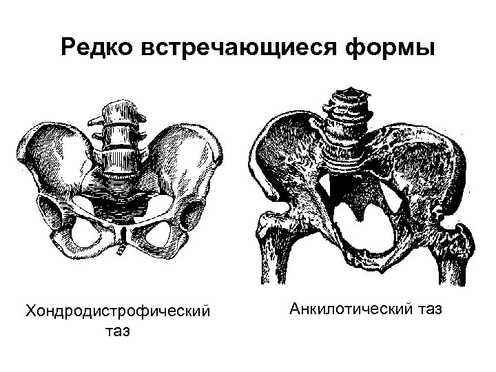 Узкий таз фото