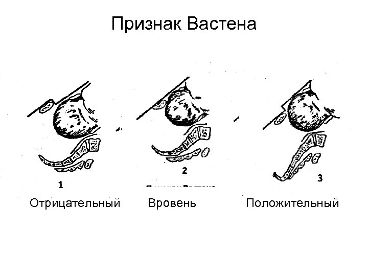 Признак Вастена Отрицательный Вровень Положительный 