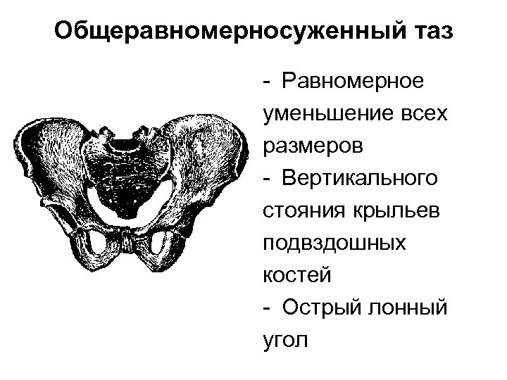 Анатомически узкий таз презентация