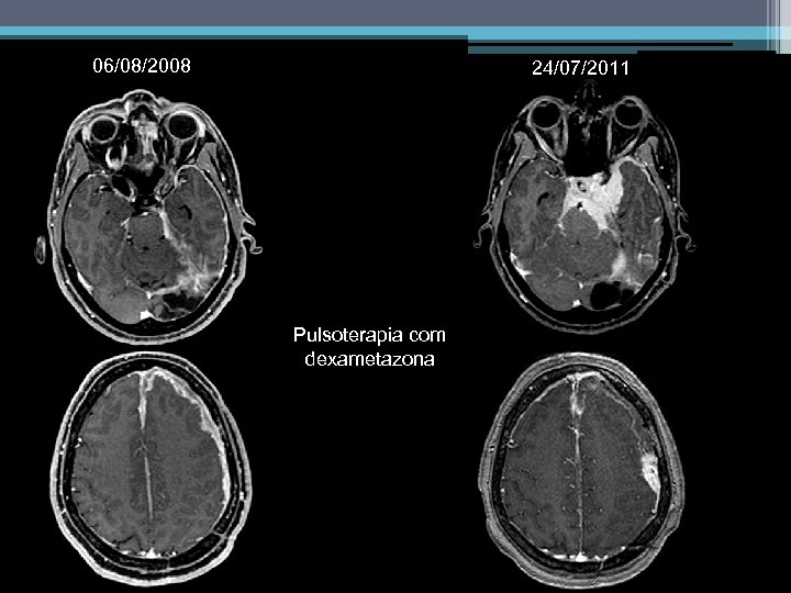 06/08/2008 24/07/2011 Pulsoterapia com dexametazona 