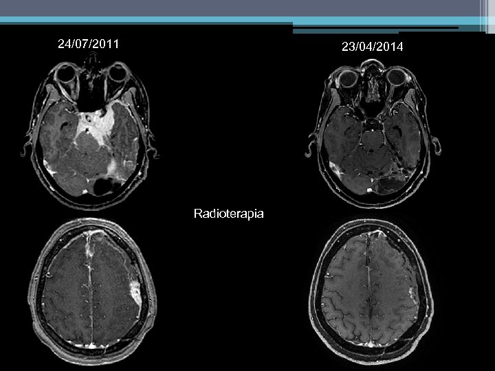 24/07/2011 23/04/2014 Radioterapia 