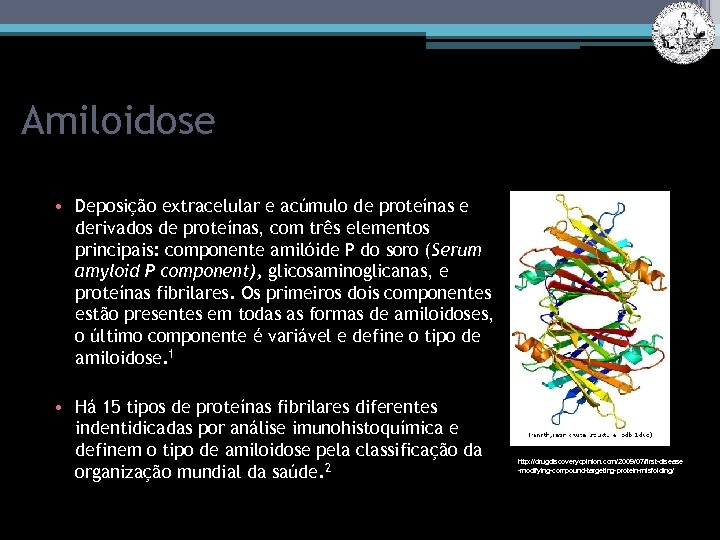 Amiloidose • Deposição extracelular e acúmulo de proteínas e derivados de proteínas, com três