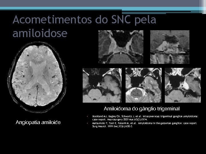 Acometimentos do SNC pela amiloidose Amiloidoma do gânglio trigeminal • Angiopatia amiloide Bookland MJ,