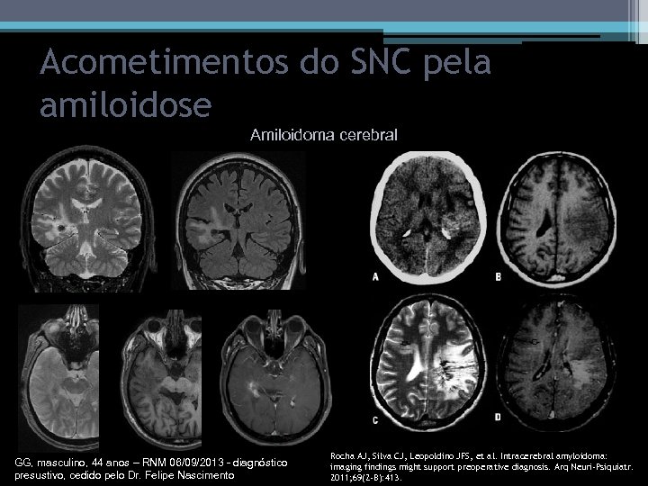 Acometimentos do SNC pela amiloidose Amiloidoma cerebral GG, masculino, 44 anos – RNM 06/09/2013