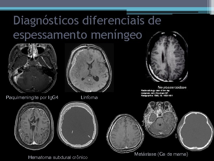 Diagnósticos diferenciais de espessamento meníngeo Neurossarcoidose Paquimeningite por Ig. G 4 Linfoma Hematoma subdural