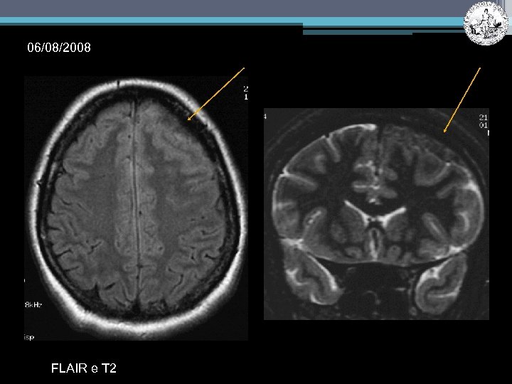 06/08/2008 FLAIR e T 2 