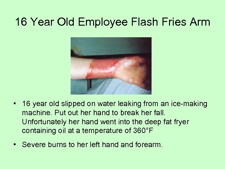 16 Year Old Employee Flash Fries Arm • 16 year old slipped on water