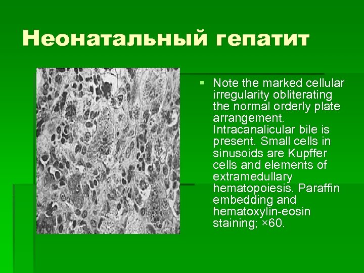 Неонатальный гепатит § Note the marked cellular irregularity obliterating the normal orderly plate arrangement.