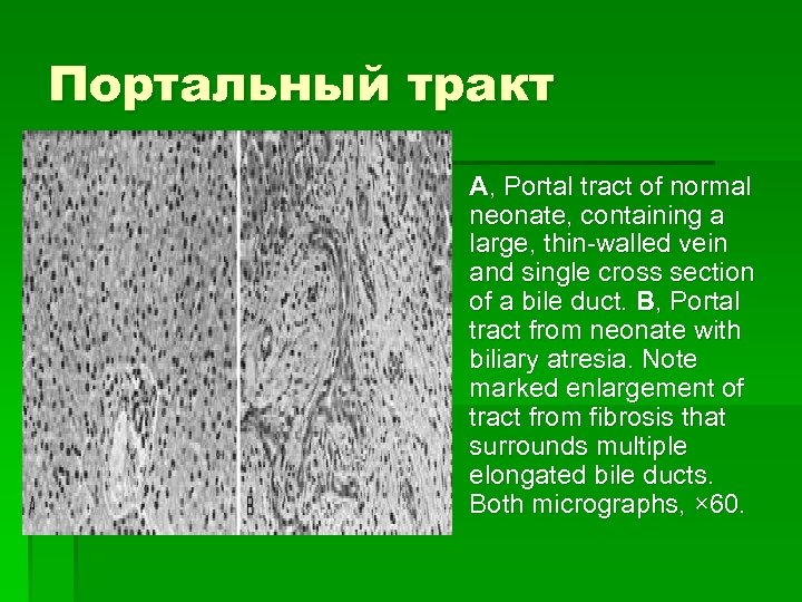 Портальный тракт § A, Portal tract of normal neonate, containing a large, thin-walled vein