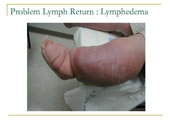 Problem Lymph Return : Lymphedema 