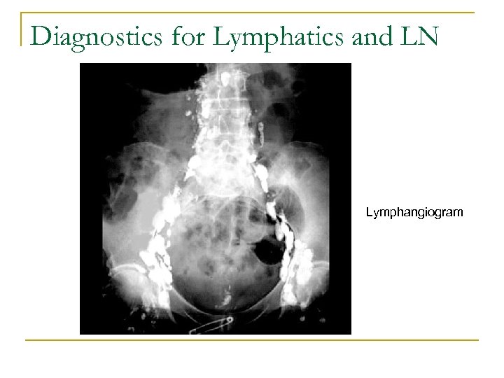 Diagnostics for Lymphatics and LN Lymphangiogram 