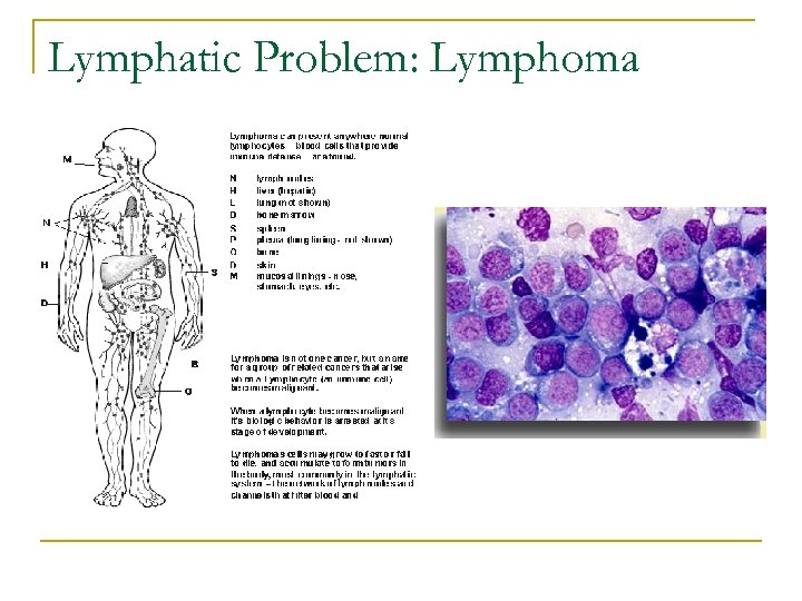 Lymphatic Problem: Lymphoma 