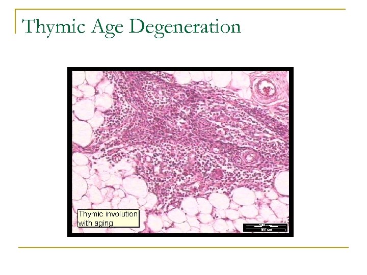 Thymic Age Degeneration 