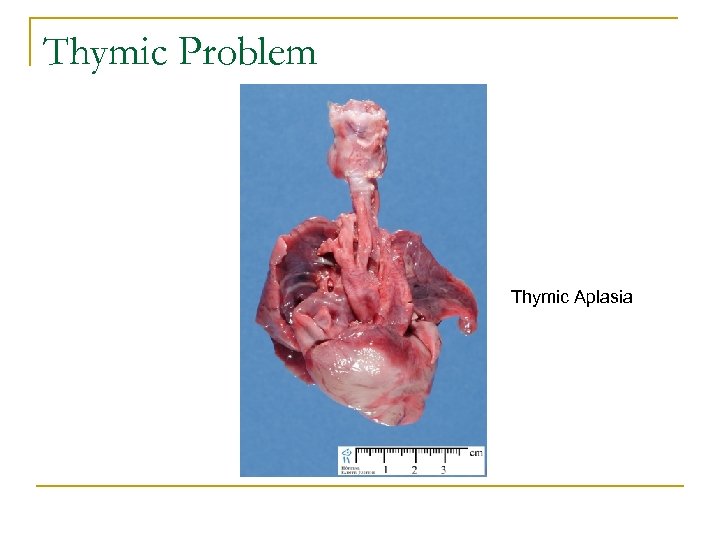 Thymic Problem Thymic Aplasia 