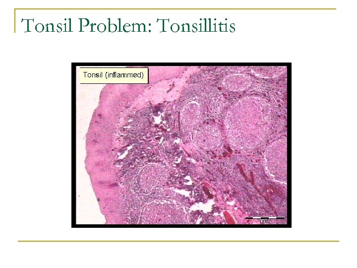 Tonsil Problem: Tonsillitis 