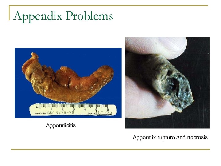 Appendix Problems Appendicitis Appendix rupture and necrosis 