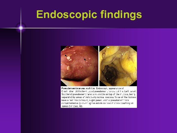 Endoscopic findings 