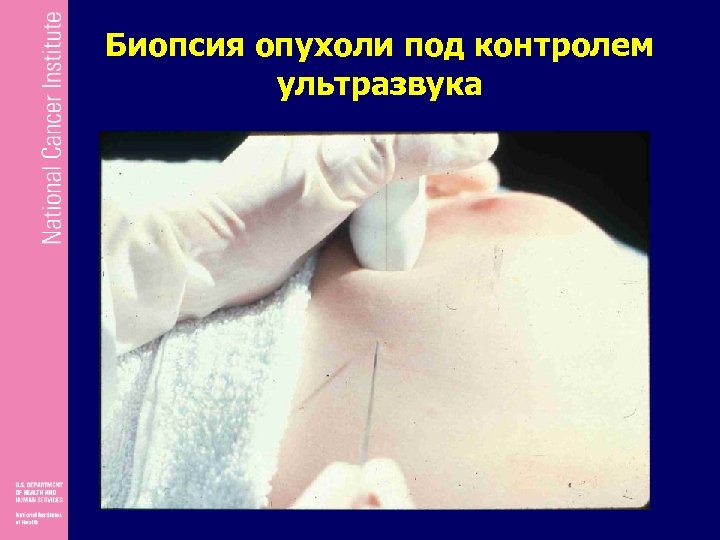 Биопсия опухоли под контролем ультразвука 